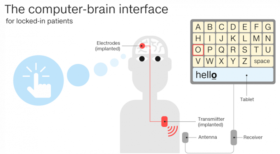 Brain implant allows ALS patient to communicate